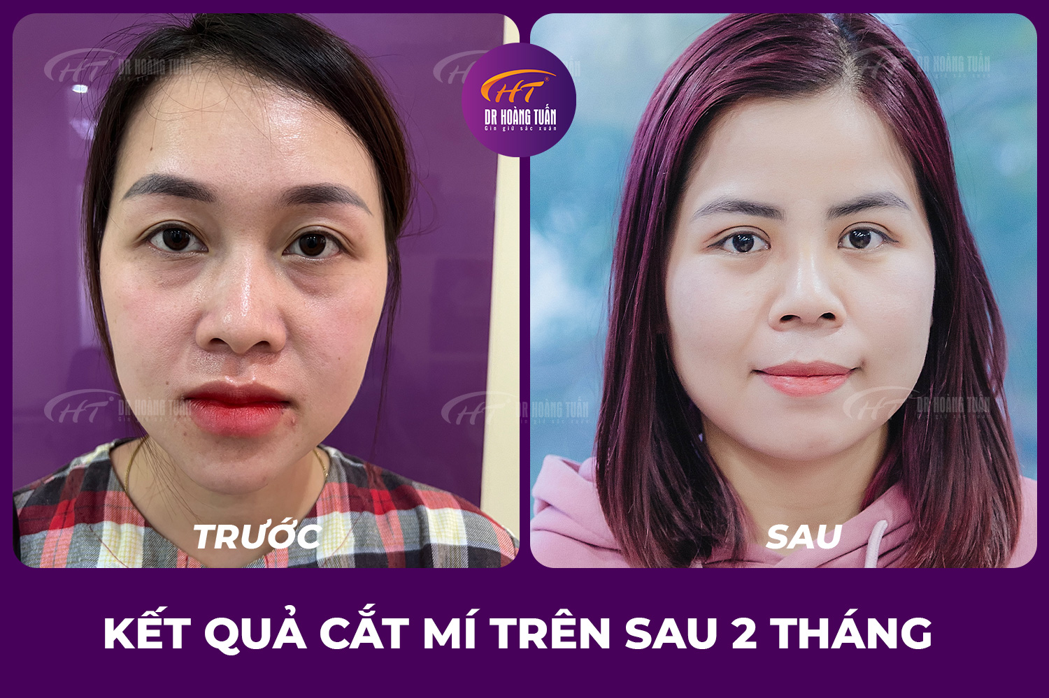 Cắt mí trên đẹp tự nhiên
